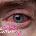 Can a Sinus Infection Cause Pink Eye